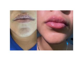 Aumento de labios Clasificados Online  Puerto Rico